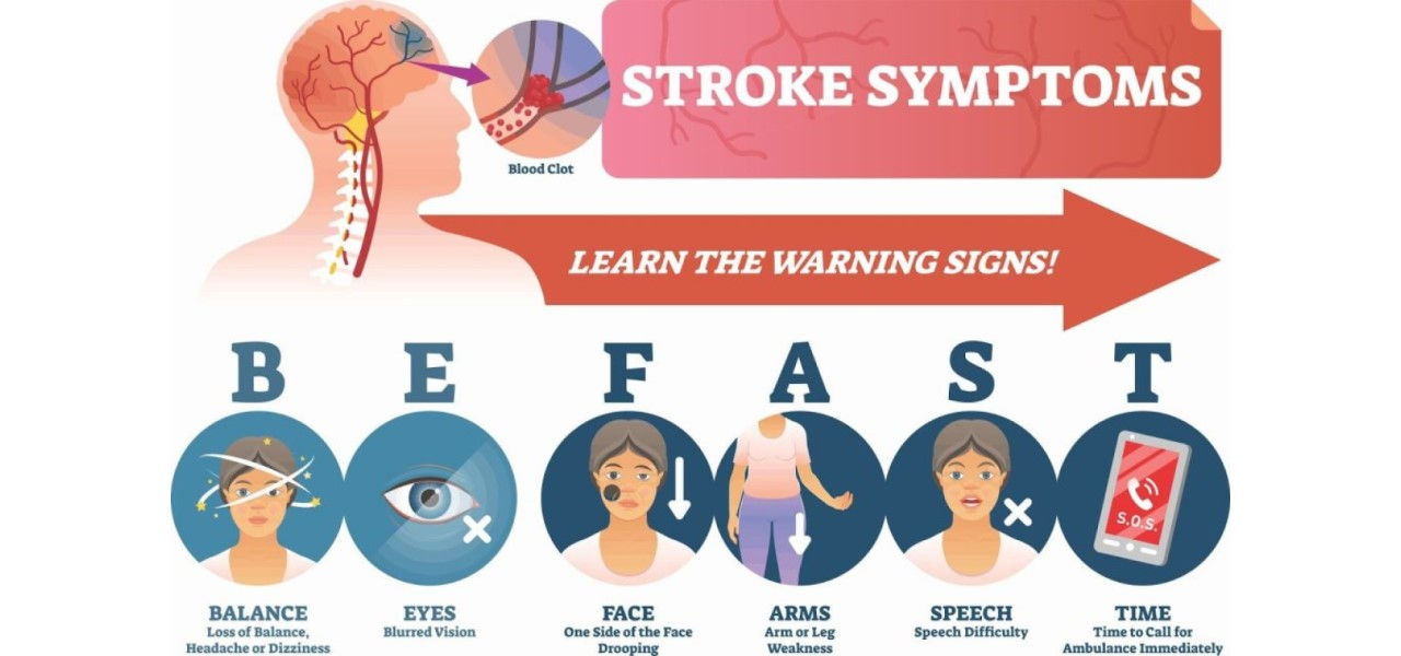 Stroke symptoms and warning signs