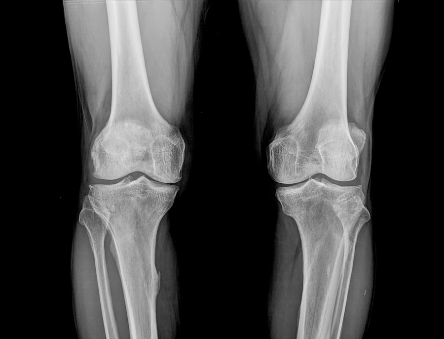 Knee Xray